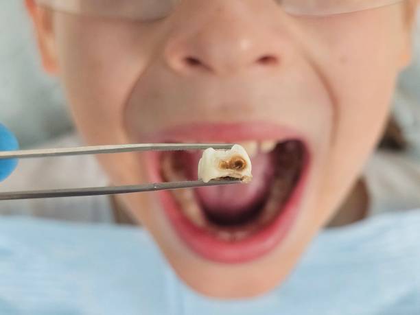 Best Urgent Care for Lost Fillings or Crowns in Seabrook, TX
